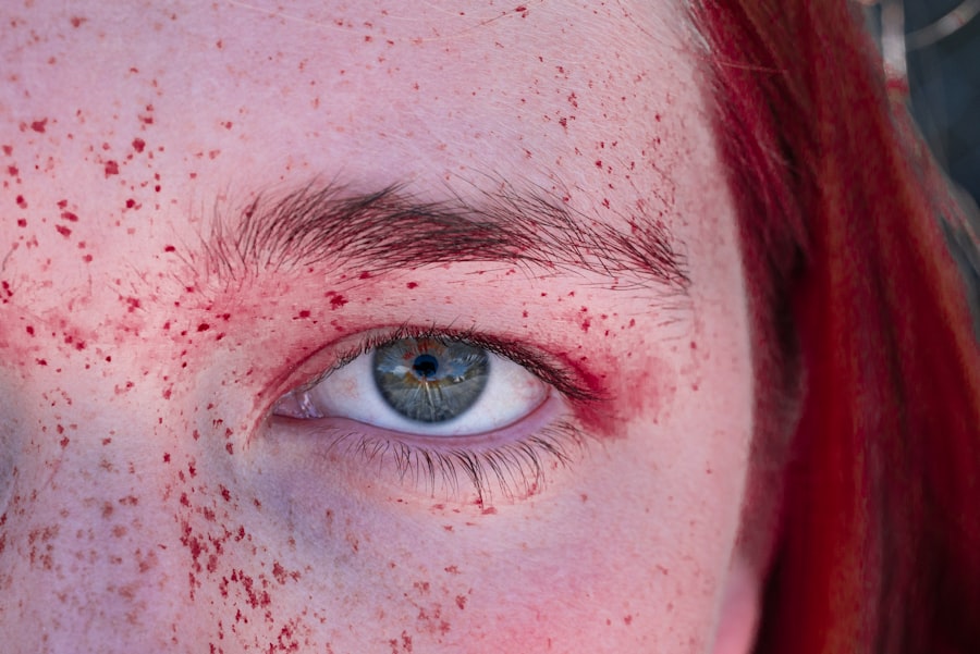 Acne Scars