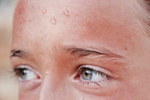 Photo Acne Scars