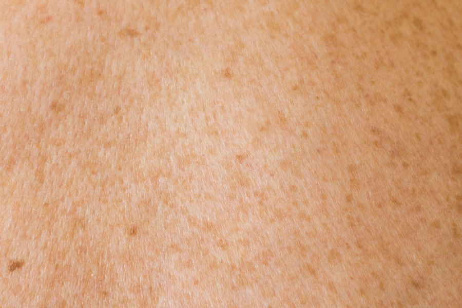 Photo Acne Scars